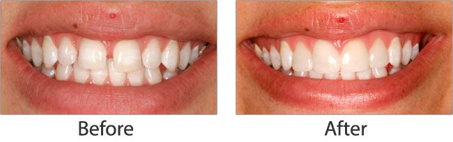 Teeth Whitening before and after 04