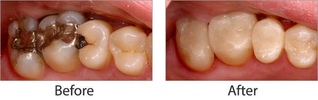 Mercury Safe Dentistry before and after results of real patient 1 near Lawrence, KS