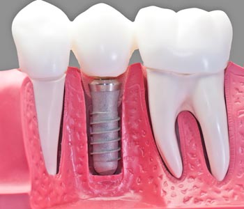 Best Dental Implants provider in Lawrence, KS area