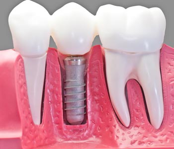 Best Dental Implants provider in Lawrence, KS area