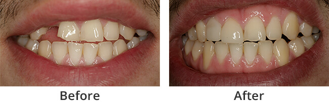 Smile Rejuvenation  before and after results of real patient 2 near Lawrence, KS